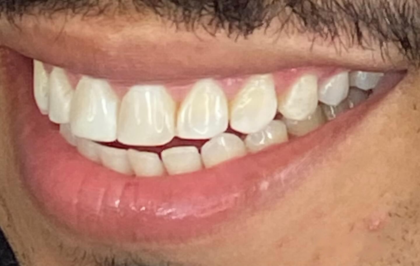 Sorriso do paciente 1 antes das facetas