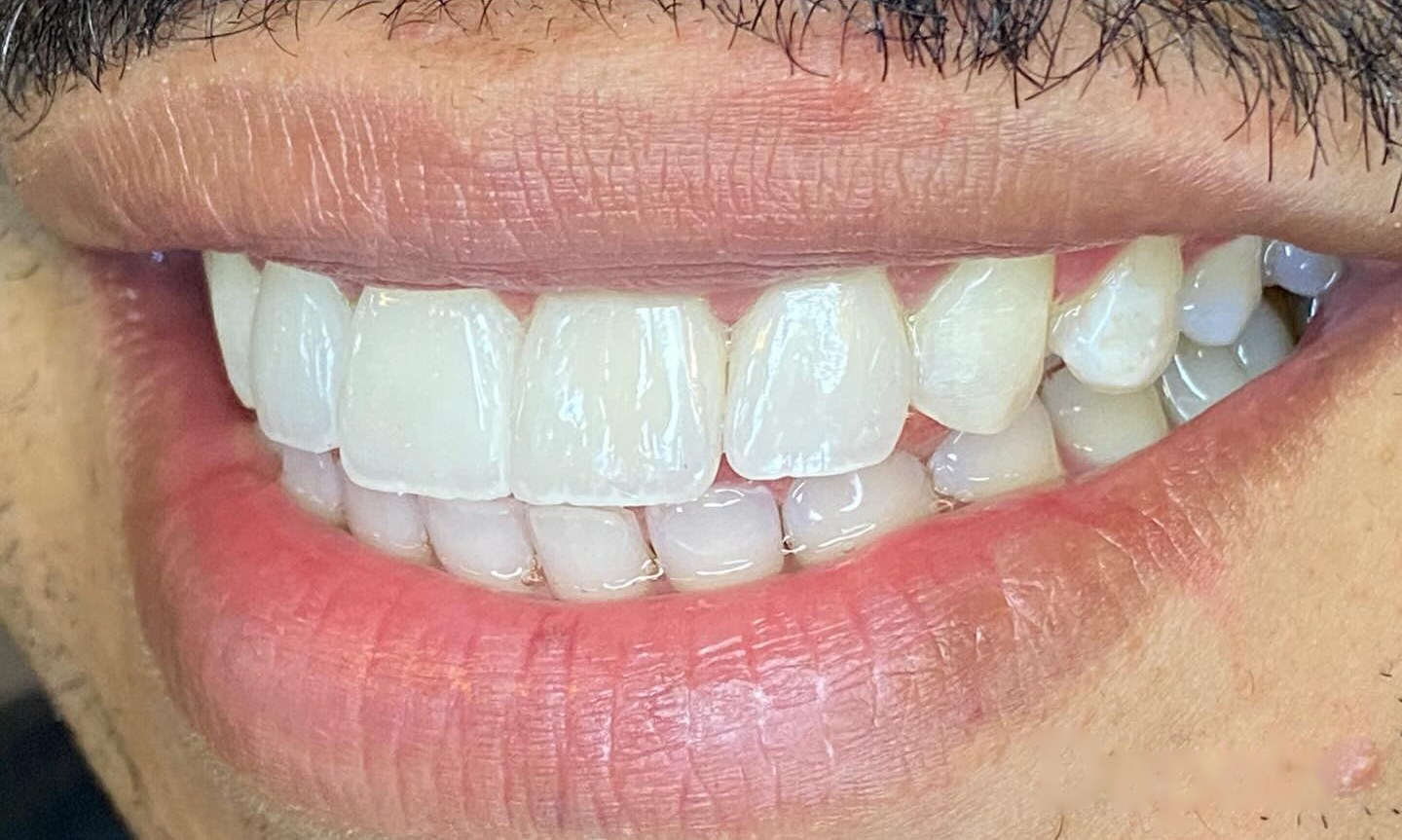 Sorriso do paciente 1 depois das facetas