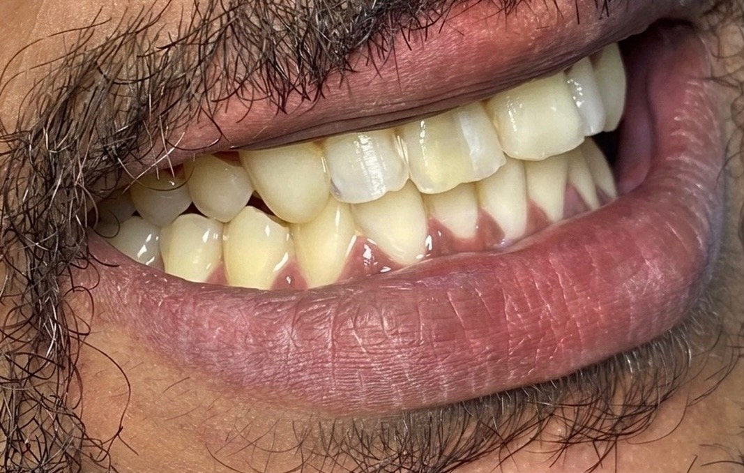 Sorriso do paciente 3 antes das facetas