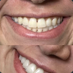 Foto do sorriso de Sara Souza após as facetas